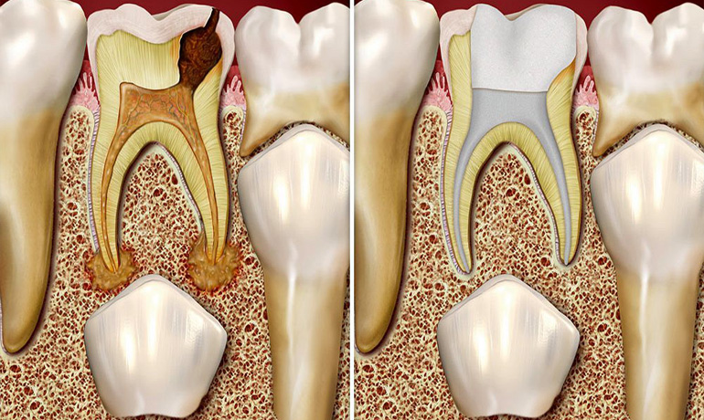 Root Canal Treatment for Kids in Vizag
