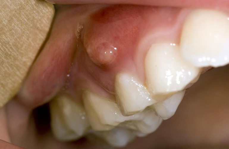 Broken Teeth Treatment in Vizag