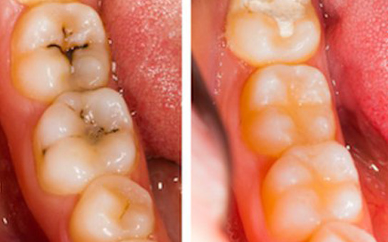 Teeth Whitening in Vizag